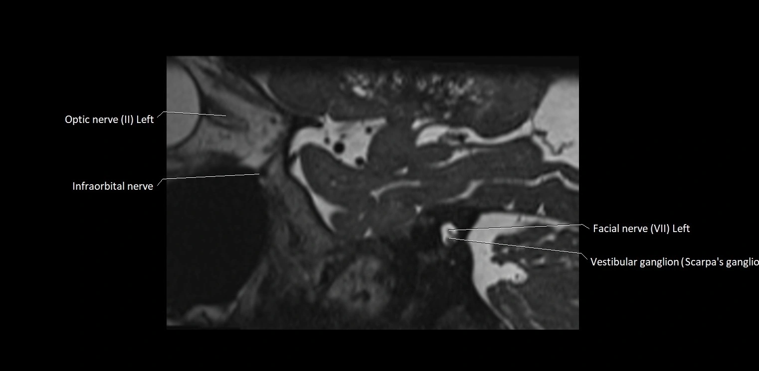 Cranial nerve sagittal anatomy MRI 3T image 12.webp